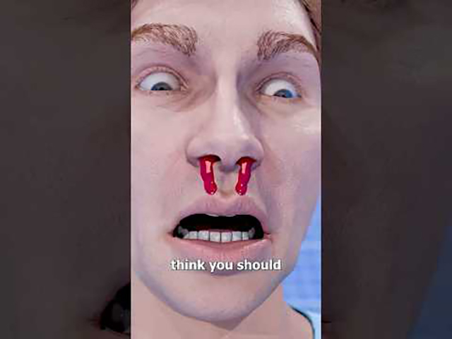 Ein Chirurg erklärt, warum man bei Nasenbluten niemals den Kopf nach hinten halten sollte